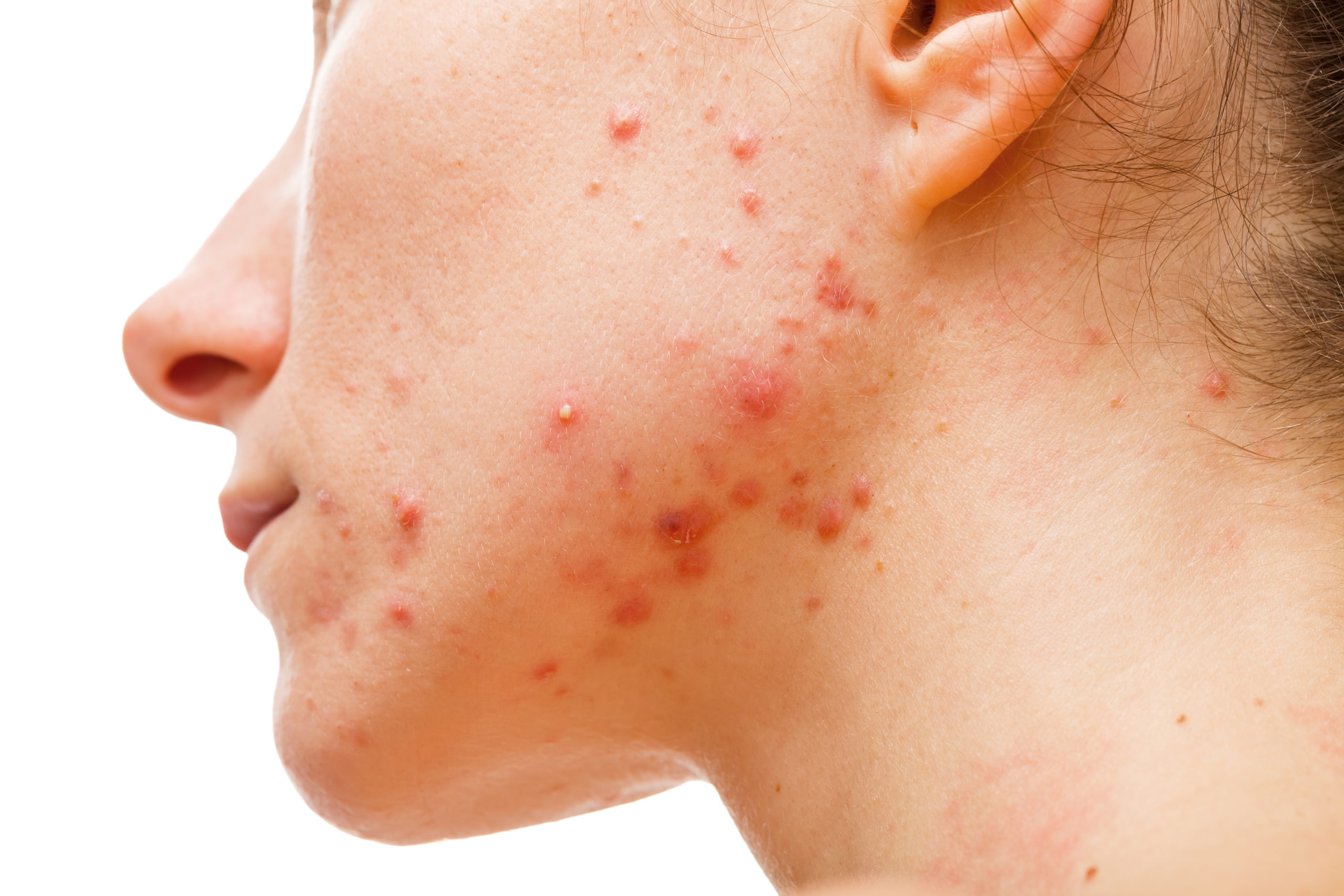 Identifying Different Types Of Acne Allen Taintor Dermatology